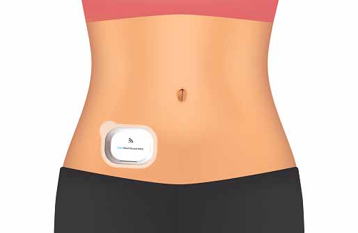 continuous glucose monitor device patched on woman stomach=